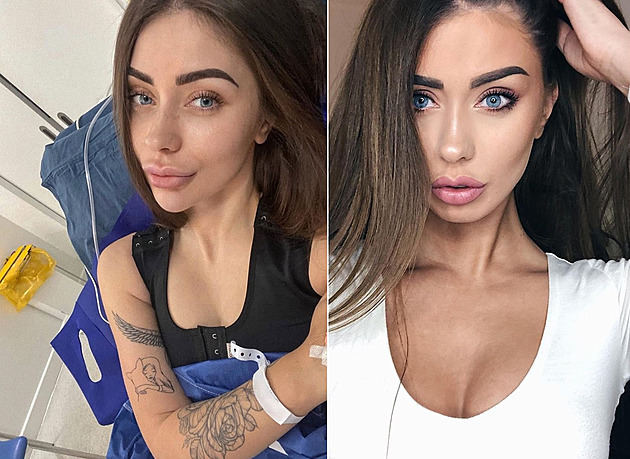 Konec kariéry kvůli implantátům? Influencerka žaluje svého lékaře